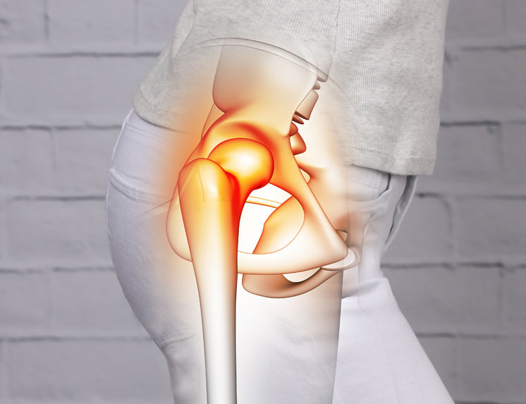 A medical illustration showing a person's hip with a translucent overlay of the hip joint's anatomy. A red highlight on the joint indicates a source of pain, injury, or inflammation.