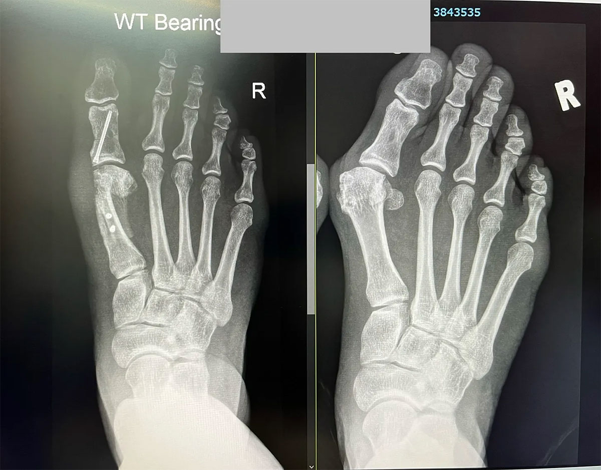  A 'before and after' X-ray comparison of a foot that has undergone bunion surgery. The 'before' image on the right shows the severe deformity, and the 'after' image on the left shows the corrected alignment held by surgical pins and screws.
