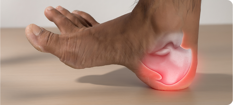 A close-up of a person holding the heel of their foot to show discomfort, with a red highlight indicating a point of chronic pain or inflammation from a condition like plantar fasciitis.