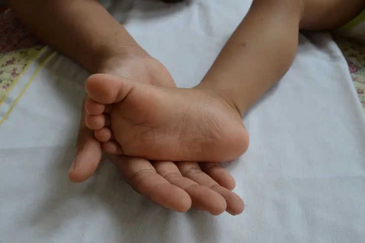 Understanding Juvenile Bunions (Bunions in Children)