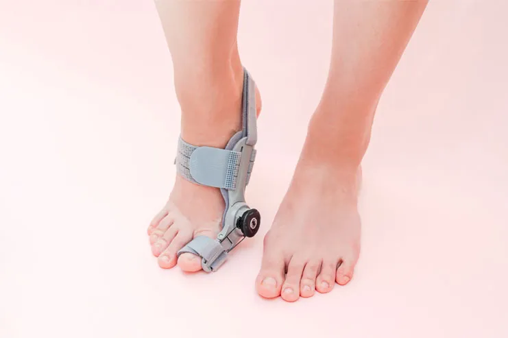 Myths & Facts About Bunions