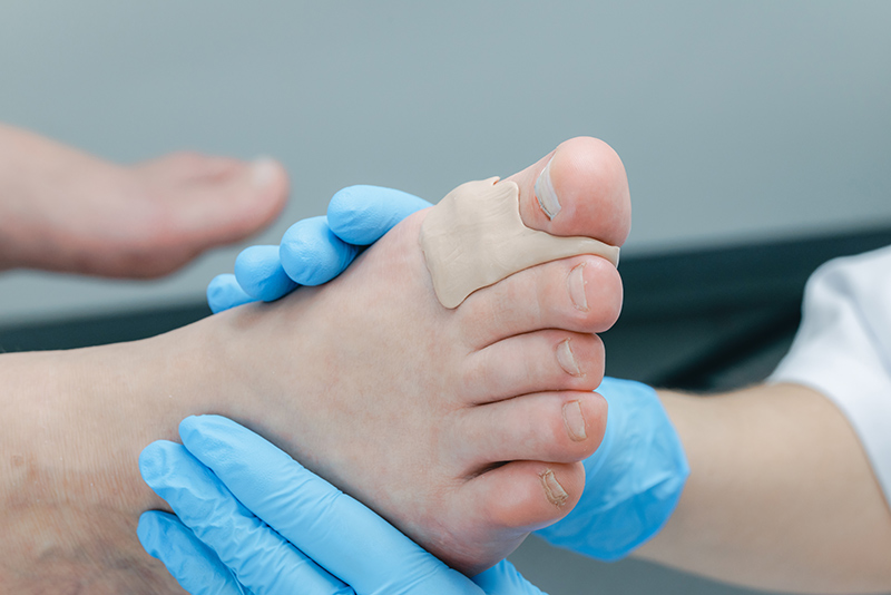 Close-up of a medical professional assessing if non-surgical care is effective on a patient's bunion.