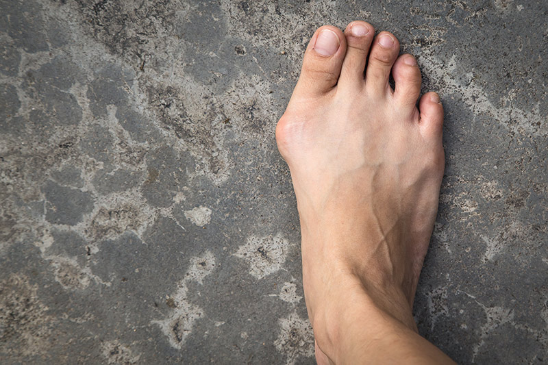 Close-up of a man with a bunion on his foot taking a step forward on firm ground